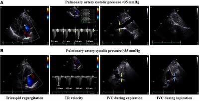 Impact of pulmonary artery pressure on recurrence after catheter ablation in patients with atrial fibrillation